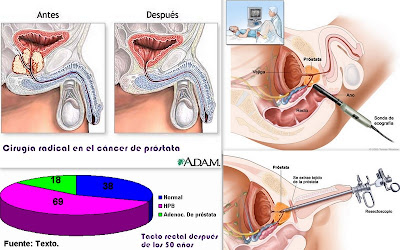 neoplasia intraepitelial de alto grado de la próstata 5 neoplasia intraepitelial de alto grado de la próstata 5